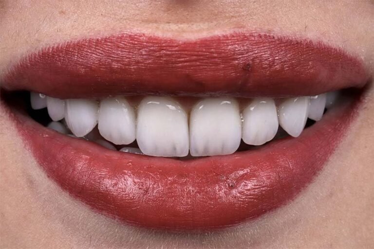 emax-dental-after