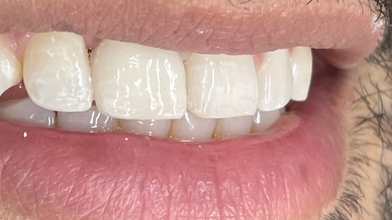 Dental-Implant-at-Midtown-Dental-Group-After-Procedure