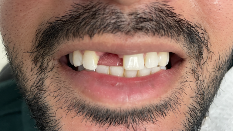 Dental-Implant-at-Midtown-Dental-Group-Before-Procedure