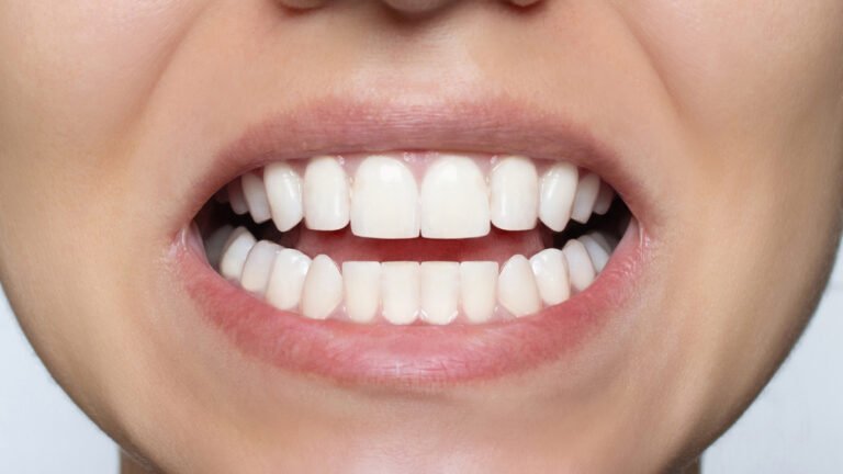 Young woman's smile before and after teeth straightening