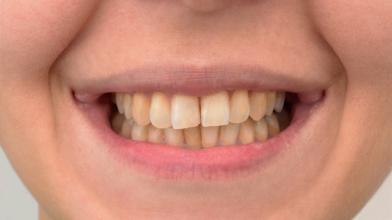 Teeth-Whitening-MDG-Before